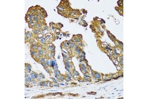 Immunohistochemistry of paraffin-embedded human colon carcinoma using SLC25A13 antibody. (slc25a13 antibody  (AA 1-300))