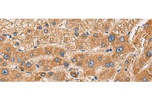 Immunohistochemistry of paraffin-embedded Human liver cancer tissue using PDHA1 Polyclonal Antibody at dilution of 1:50(x200) (PDHA1 antibody)