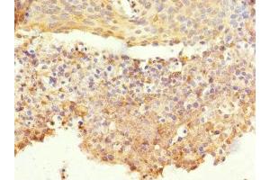 Immunohistochemistry of paraffin-embedded human cervical cancer using ABIN7148605 at dilution of 1:100 (CORO1C antibody  (AA 375-474))