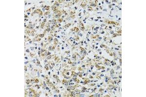 Immunohistochemistry of paraffin-embedded human uterine cancer using TXN2 antibody. (TXN2 antibody  (AA 1-166))