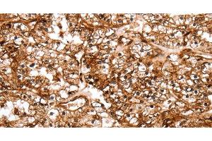 Immunohistochemistry of paraffin-embedded Human renal cancer tissue using SLC9A3R2 Polyclonal Antibody at dilution 1:40 (SLC9A3R2 antibody)