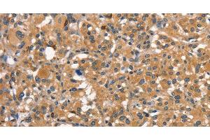 Immunohistochemistry of paraffin-embedded Human thyroid cancer using DNM2 Polyclonal Antibody at dilution of 1:40 (DNM2 antibody)