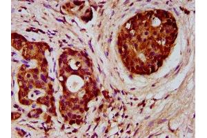 IHC image of ABIN7152390 diluted at 1:300 and staining in paraffin-embedded human pancreatic cancer performed on a Leica BondTM system. (FCHO1 antibody  (AA 45-180))