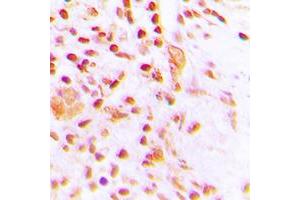 Immunohistochemical analysis of ETV4 staining in human lung cancer formalin fixed paraffin embedded tissue section. (ETV4 antibody  (Center))