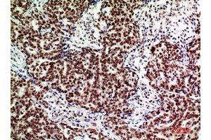Immunohistochemistry (IHC) analysis of paraffin-embedded Human Breast Cancer, antibody was diluted at 1:200. (ACER2 antibody)