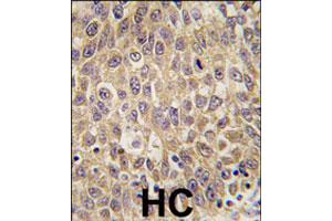 Formalin-fixed and paraffin-embedded human hepatocellular carcinoma reacted with AFP polyclonal antibody  , which was peroxidase-conjugated to the secondary antibody, followed by DAB staining. (alpha Fetoprotein antibody  (N-Term))