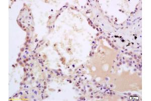Formalin-fixed and paraffin embedded human lung carcinoma labeled with Rabbit Anti phospho-SHC(Tyr239/240) Polyclonal Antibody, Unconjugated (ABIN745973) at 1:200 followed by conjugation to the secondary antibody and DAB staining (SHC1 antibody  (pTyr349, pTyr350))