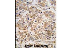 Formalin-fixed and paraffin-embedded human breast carcinoma tissue reacted with IKKE Antibody (C-term) (ABIN392751 and ABIN2842204) , which was peroxidase-conjugated to the secondary antibody, followed by DAB staining. (IKKi/IKKe antibody  (C-Term))