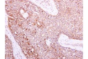 IHC-P Image NOX1 antibody detects NOX1 protein at cytoplasm on human lung carcinoma by immunohistochemical analysis.