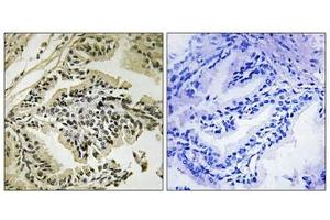 Immunohistochemical analysis of paraffin-embedded human prostate carcinoma tissue using PEK/PERK (Phospho-Thr982) antibody (left)or the same antibody preincubated with blocking peptide (right). (PERK antibody  (pThr981))