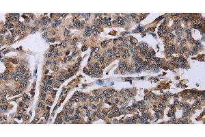 Immunohistochemistry of paraffin-embedded Human breast cancer tissue using DDX11 Polyclonal Antibody at dilution 1:30 (DDX11 antibody)