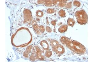 Formalin-fixed, paraffin-embedded human Breast Carcinoma stained with STAT5B Mouse Monoclonal Antibody (STAT5B/2611). (STAT5B antibody)