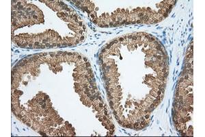 Immunohistochemical staining of paraffin-embedded Adenocarcinoma of Human colon tissue using anti-ACAT2 mouse monoclonal antibody. (ACAT2 antibody)