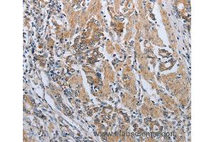 Immunohistochemistry of Human lung cancer using PDCD1 Polyclonal Antibody at dilution of 1:50 (PD-1 antibody)