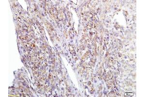 Formalin-fixed and paraffin embedded human cervical carcinoma labeled with Anti APE/Girdin Polyclonal Antibody, Unconjugated  at 1:200 followed by conjugation to the secondary antibody and DAB staining