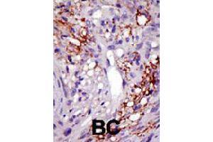Formalin-fixed and paraffin-embedded human cancer tissue reacted with USP22 polyclonal antibody  , which was peroxidase-conjugated to the secondary antibody, followed by DAB staining . (USP22 antibody  (C-Term))