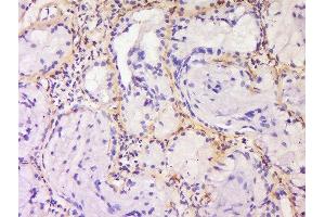 Formalin-fixed and paraffin embedded human laryngocarcinoma labeled with Anti-SPRR3/Cornifin B Polyclonal Antibody, Unconjugated  at 1:200 followed by conjugation to the secondary antibody and DAB staining. (SPRR3 antibody  (AA 21-100))