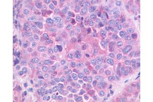 Anti-GRPR antibody IHC of human Lung, Non-Small Cell Carcinoma. (GRPR antibody  (Extracellular Domain))