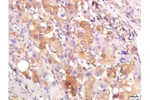 Paraformaldehyde-fixed, paraffin embedded human liver cancer, Antigen retrieval by boiling in sodium citrate buffer (pH6) for 15min, Block endogenous peroxidase by 3% hydrogen peroxide for 30 minutes, Blocking buffer (normal goat serum) at 37°C for 20min, Antibody incubation with Rabbit Anti-Arginase 1 Polyclonal Antibody, Unconjugated  at 1:200 overnight at 4°C, followed by a conjugated secondary and DAB staining. (Liver Arginase antibody  (AA 151-220))