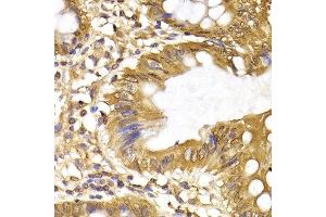 Immunohistochemistry of paraffin-embedded human colon cancer using IRF6 antibody at dilution of 1:200 (400x lens). (IRF6 antibody)