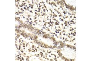 Immunohistochemistry of paraffin-embedded human gastric cancer using LMNB2 Antibody (ABIN5973877) at dilution of 1/200 (40x lens).