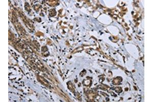 The image on the left is immunohistochemistry of paraffin-embedded Human breast cancer tissue using ABIN7129587(GDF3 Antibody) at dilution 1/25, on the right is treated with fusion protein. (GDF3 antibody)