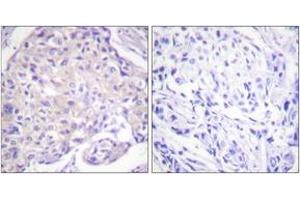 Immunohistochemistry analysis of paraffin-embedded human breast carcinoma, using PAK1 (Phospho-Thr212) Antibody.