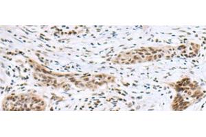 Immunohistochemistry of paraffin-embedded Human esophagus cancer tissue using INSM1 Polyclonal Antibody at dilution of 1:50(x200) (INSM1 antibody)