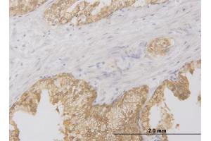 Immunoperoxidase of monoclonal antibody to RIPK2 on formalin-fixed paraffin-embedded human prostate. (RIPK2 antibody  (AA 431-540))