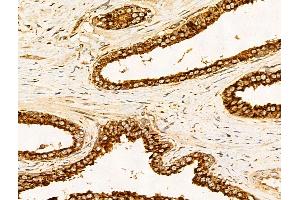 ABIN7094814 and ABIN7098865 at 1/100 staining Human colorectal cancer by IHC-P. (Filaggrin antibody  (C-Term))