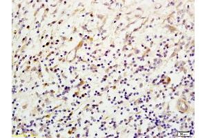 Formalin-fixed and paraffin embedded human esophageal carcinoma labeled with Anti- Mannan Binding Lectin Polyclonal Antibody, Unconjugated (ABIN731663) at 1:200, followed by conjugation to the secondary antibody and DAB staining. (MBP/MBL antibody  (AA 31-130))