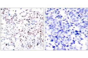 Immunohistochemical analysis of paraffin-embedded human breast carcinoma tissue using Myc(Phospho-Thr358) Antibody(left) or the same antibody preincubated with blocking peptide(right). (c-MYC antibody  (pThr358))