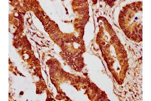 IHC image of nme1HU diluted at 1:10 and staining in paraffin-embedded human colon cancer performed on a Leica BondTM system.