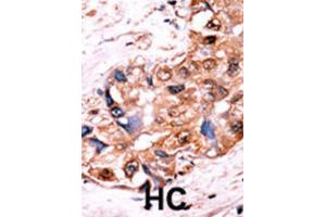 Immunohistochemistry (IHC) image for anti-V-Yes-1 Yamaguchi Sarcoma Viral Oncogene Homolog 1 (YES1) (pTyr530), (pTyr537) antibody (ABIN5978609) (YES1 antibody  (pTyr530, pTyr537))