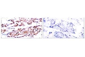 Immunohistochemical analysis of paraffin-embedded human breast carcinoma tissue using JunB (phospho- Ser79) antibody (E011026). (JunB antibody  (pSer79))