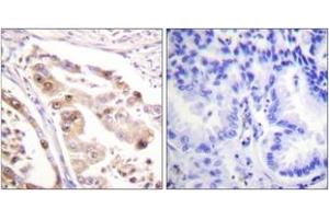 Immunohistochemistry analysis of paraffin-embedded human lung carcinoma tissue, using RFA2 (Ab-21) Antibody. (RPA2 antibody  (AA 10-59))