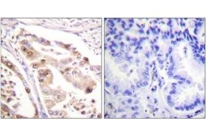 Immunohistochemistry analysis of paraffin-embedded human lung carcinoma tissue, using RFA2 (Ab-21) Antibody. (RPA2 antibody  (AA 10-59))