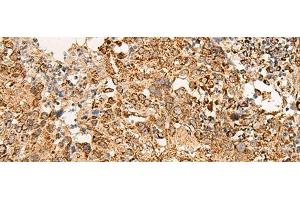 Immunohistochemistry of paraffin-embedded Human cervical cancer tissue using ATP5I Polyclonal Antibody at dilution of 1:65(x200) (ATP5I antibody)