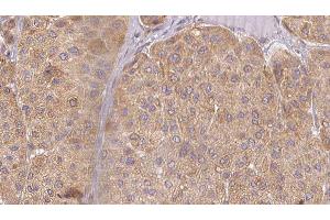 ABIN6277526 at 1/100 staining Human Melanoma tissue by IHC-P. (BPI antibody  (Internal Region))