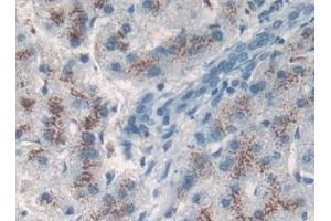 Detection of TP53TG5 in Human Liver cancer Tissue using Polyclonal Antibody to TP53 Target Gene 5 (TP53TG5) (TP53TG5 antibody  (AA 190-262))
