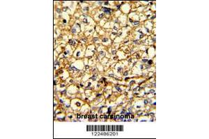 Formalin-fixed and paraffin-embedded human breast carcinoma with ADRA2B Antibody , which was peroxidase-conjugated to the secondary antibody, followed by DAB staining. (ADRA2B antibody  (AA 343-369))
