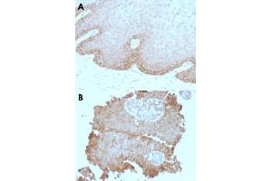 Immunohistochemical staining (Formalin-fixed paraffin-embedded sections) of human cervical carcinoma (A) and human bladder carcinoma (B) with FAT2 monoclonal antibody, clone 8C5 .
