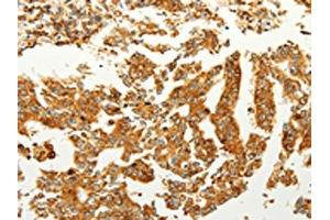 The image on the left is immunohistochemistry of paraffin-embedded Human gastric cancer tissue using ABIN7190727(FZD6 Antibody) at dilution 1/60, on the right is treated with synthetic peptide.
