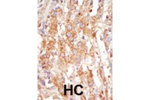Formalin-fixed and paraffin-embedded human cancer tissue reacted with the primary antibody, which was peroxidase-conjugated to the secondary antibody, followed by DAB staining. (MAP3K6 antibody  (C-Term))