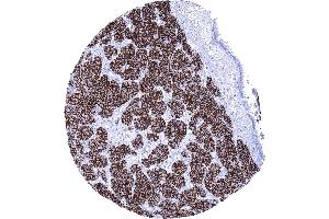 Strong membranous CD56 staining in a neuroendocrine tumor of the lung