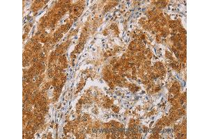 Immunohistochemistry of Human colon cancer using CENPE Polyclonal Antibody at dilution of 1:50