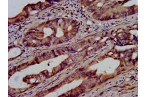 IHC image of ABIN7174451 diluted at 1:500 and staining in paraffin-embedded human colon cancer performed on a Leica BondTM system. (UBE2G1 antibody  (AA 2-170))