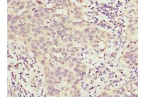 Immunohistochemistry of paraffin-embedded human bladder cancer using ABIN7155761 at dilution of 1:100 (HOXD1 antibody  (AA 1-240))