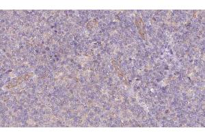 ABIN6273074 at 1/100 staining Human lymph cancer tissue by IHC-P. (SNAPIN antibody  (N-Term))