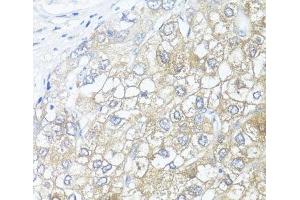 Immunohistochemistry of paraffin-embedded Human liver cancer using ASL Polyclonal Antibody at dilution of 1:100 (40x lens). (ASL antibody)